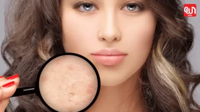 Acne scar