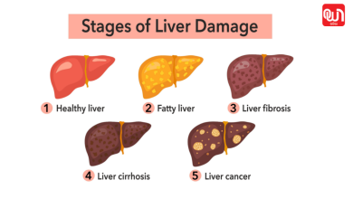 Grade 1 Fatty Liver