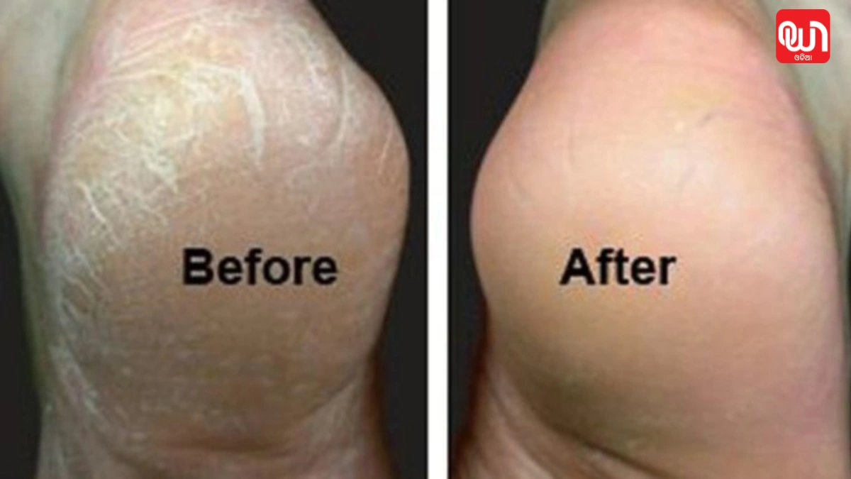 Cracked Heels Treatment
