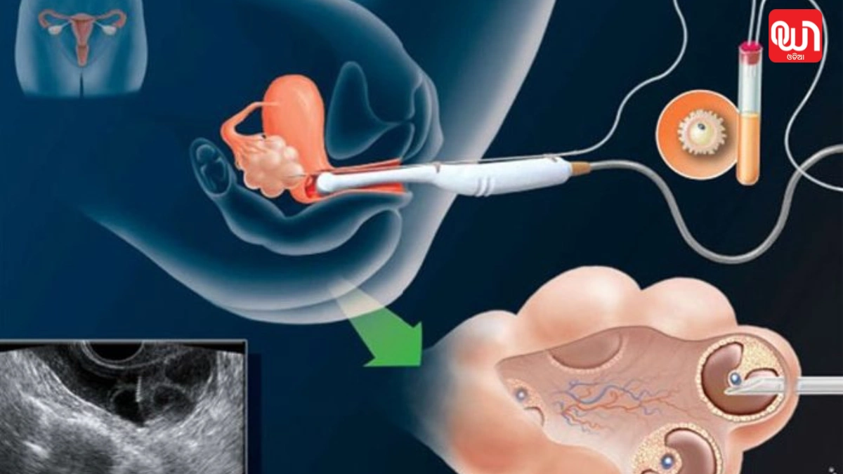 How long does it take to get pregnant through IVF (1)