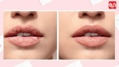 Chapped Lips