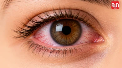 Dry Eye Syndrome